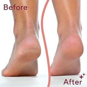 Electric-feet-callus-removers